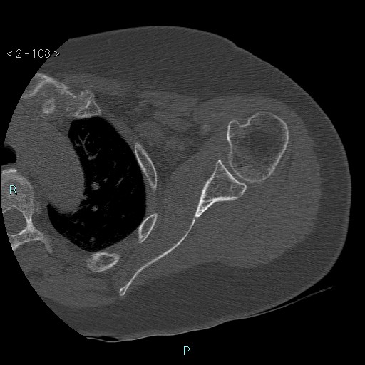 File:Avascular necrosis of the shoulder - Cruess stage I (Radiopaedia 77674-89887 Axial bone window 27).jpg
