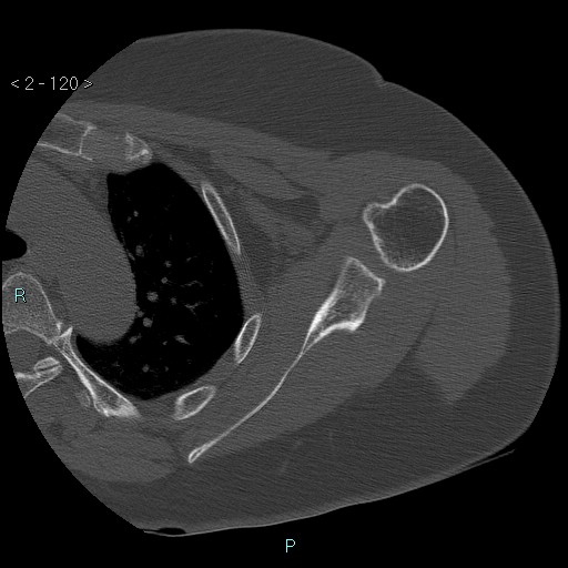 Avascular necrosis of the shoulder - Cruess stage I (Radiopaedia 77674-89887 Axial bone window 30).jpg