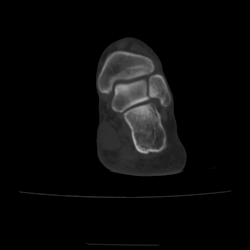Avulsion fracture of the dorsal cuboid bone (Radiopaedia 51586-57377 Axial bone window 14).jpg