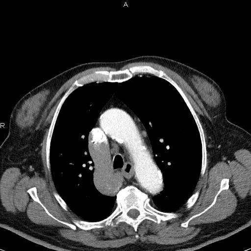 Azygos continuation of the inferior vena cava (Radiopaedia 18537-18404 C+ arterial phase 20).jpg