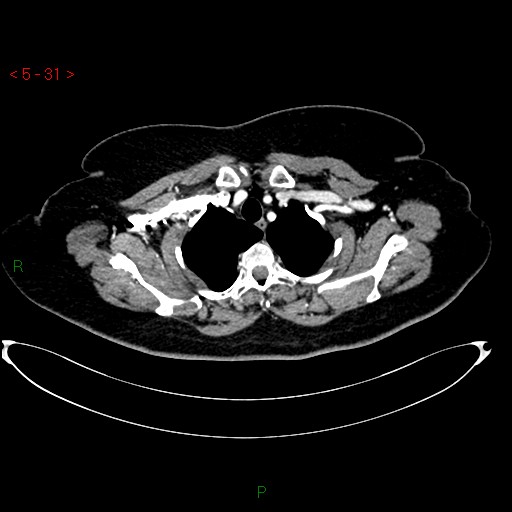 File:Azygos fissure and lobe (Radiopaedia 47620-52278 A 17).jpg