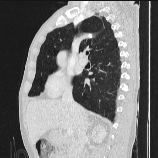 Azygos lobe (Radiopaedia 38259-40275 lung window 42).jpg