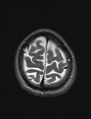 File:Balo concentric sclerosis (Radiopaedia 50458-55940 Axial T2 4).jpg