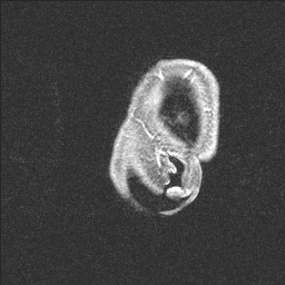 Balo concentric sclerosis (Radiopaedia 50458-55940 Sagittal T1 C+ 11).jpg