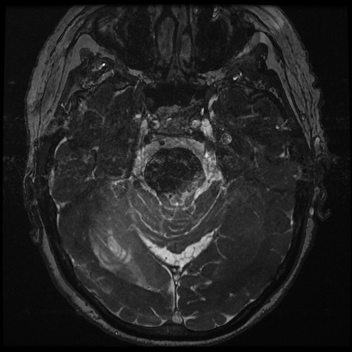 File:Balo concentric sclerosis (Radiopaedia 53875-59982 Axial T2 FIESTA 62).jpg