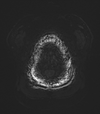 Basal ganglia hemorrhage - hypertensive (Radiopaedia 42227-45303 Axial SWI 88).png