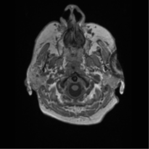 File:Basal ganglia metastasis (Radiopaedia 78928-91828 Axial T1 1).png