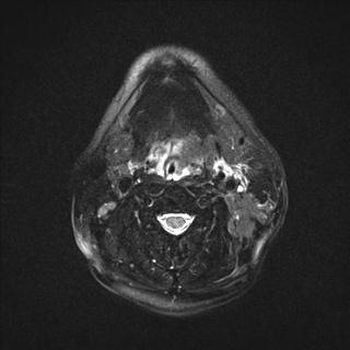 File:Base of tongue squamous cell carcinoma (Radiopaedia 31174-31884 Axial T2 fat sat 9).jpg