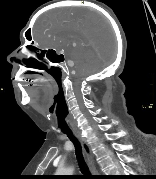 Basilar artery aneurysm (Radiopaedia 56261-62932 C 30).jpg