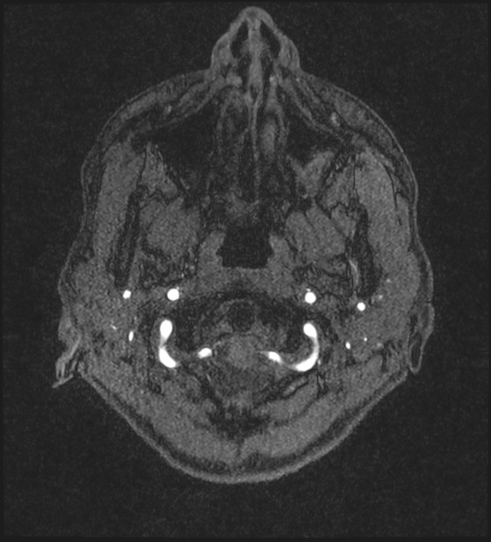 Basilar artery perforator aneurysm (Radiopaedia 82455-97733 Axial MRA 5).jpg