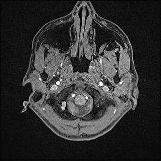 Basilar artery perforator aneurysm (Radiopaedia 82455-97733 Axial T1 fat sat 5).jpg