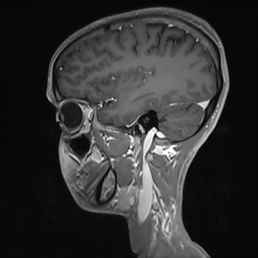 File:Basilar artery perforator aneurysm (Radiopaedia 82455-97733 G 43).jpg