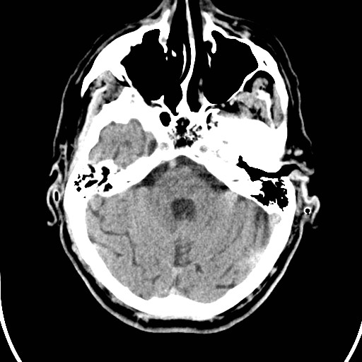 File:Basilar artery thrombosis (Radiopaedia 26986-27162 Axial non-contrast 9).jpg