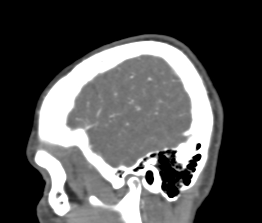File:Basilar tip aneurysm with coiling (Radiopaedia 53912-60086 C 13).jpg