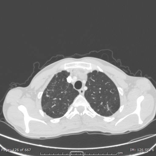 Behçet disease (Radiopaedia 44247-47889 Axial lung window 12).jpg