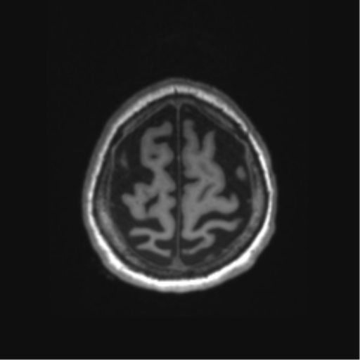 Behavioral variant frontotemporal dementia and late onset schizophrenia (Radiopaedia 52197-58083 Axial T1 2).png