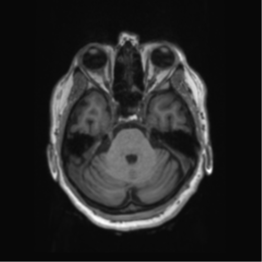 Behavioral variant frontotemporal dementia and late onset schizophrenia (Radiopaedia 52197-58083 Axial T1 79).png
