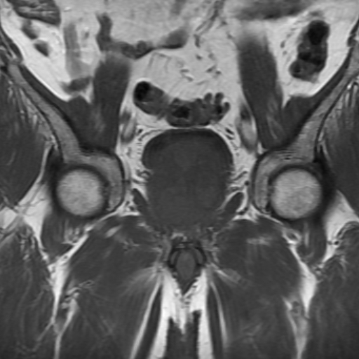 File:Benign prostatic nodular hyperplasia (Radiopaedia 16917-16634 Coronal T1 8).jpg
