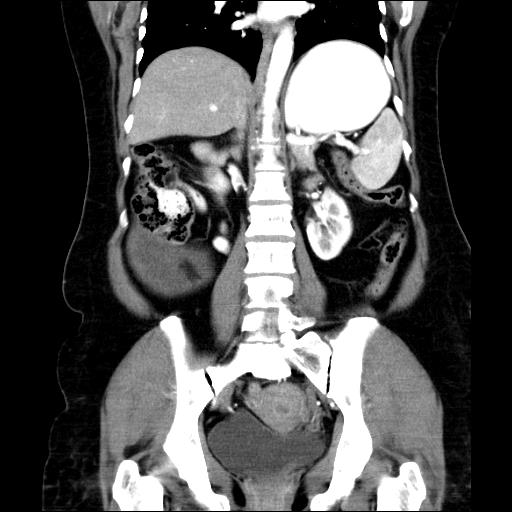 File:Benign spindle cell tumor - abdominopelvic (Radiopaedia 61300-69212 C 36).jpg