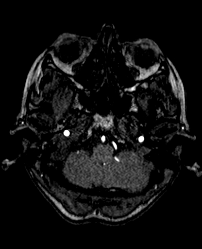 Berry aneurysm of the terminal internal carotid artery (Radiopaedia 88286-104918 Axial TOF 58).jpg