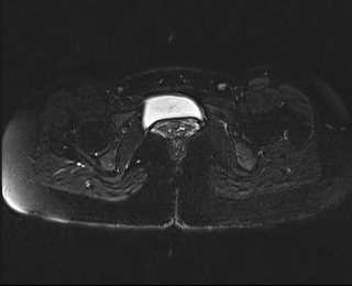 File:Bicornuate bicollis uterus (Radiopaedia 61626-69616 Axial PD fat sat 29).jpg