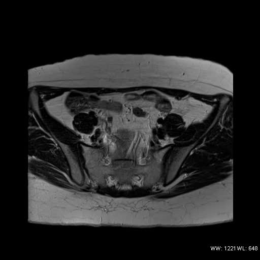 File:Bicornuate uterus- on MRI (Radiopaedia 49206-54297 Axial T2 2).jpg