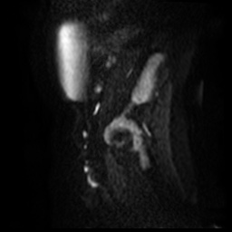 File:Bicornuate uterus (Radiopaedia 51676-57472 Sagittal DWI 28).jpg