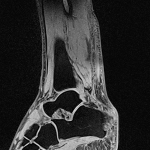 Bilateral Achilles tendon complete tear (Radiopaedia 81344-95051 Sagittal WE - Left 74).jpg