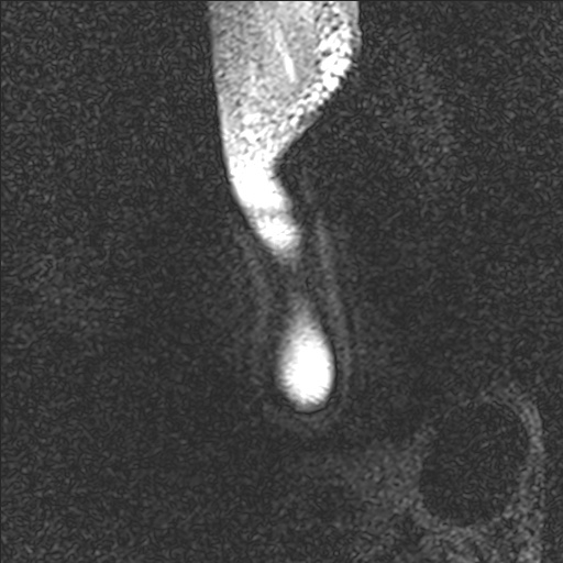 Bilateral Achilles tendon complete tear (Radiopaedia 81344-95051 Sagittal WE - Right 4).jpg