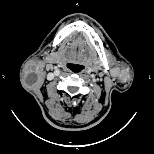Bilateral Warthin tumors (Radiopaedia 84034-99263 Axial With contrast 31).jpg