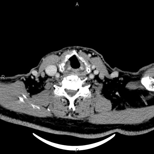 Bilateral Warthin tumors (Radiopaedia 84034-99263 Axial With contrast 47).jpg