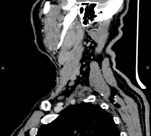 Bilateral Warthin tumors (Radiopaedia 84034-99263 D 24).jpg