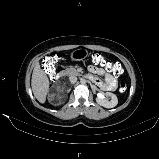 Bilateral adrenal myelolipoma (Radiopaedia 63058-71535 Axial C+ delayed 44).jpg
