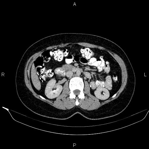 Bilateral adrenal myelolipoma (Radiopaedia 63058-71535 Axial C+ delayed 56).jpg