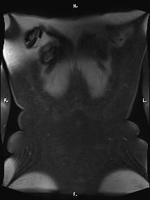 Bilateral adrenal myelolipoma (Radiopaedia 63058-71537 Coronal T1 fat sat 4).jpg
