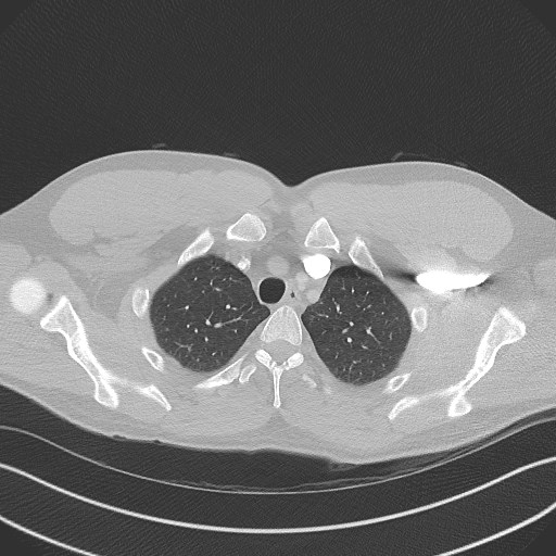 Bilateral atelectasis (Radiopaedia 48666-53675 Axial lung window 16).jpg