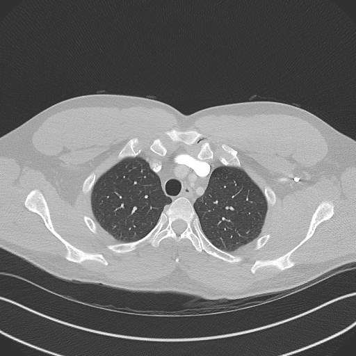 Bilateral atelectasis (Radiopaedia 48666-53675 Axial lung window 19).jpg