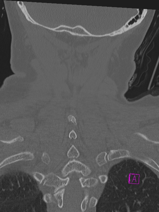 Bilateral atlanto-occipital assimilation (Radiopaedia 28350-28603 Coronal bone window 41).jpg