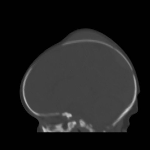 File:Bilateral cephalohematomas and subdural hematomas (Radiopaedia 26778-26929 Sagittal bone window 25).jpg