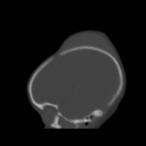 File:Bilateral cephalohematomas and subdural hematomas (Radiopaedia 26778-26929 Sagittal bone window 8).jpg