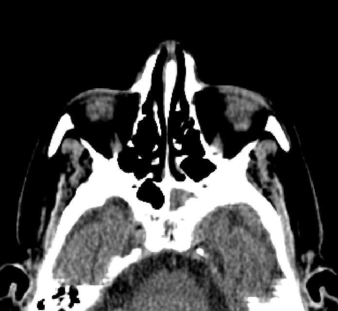 Bilateral ectopia lentis (Radiopaedia 89889-107013 Axial non-contrast 63).jpg