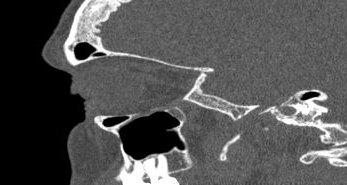 File:Bilateral ectopic infraorbital nerves (Radiopaedia 49006-54084 Sagittal 25).png
