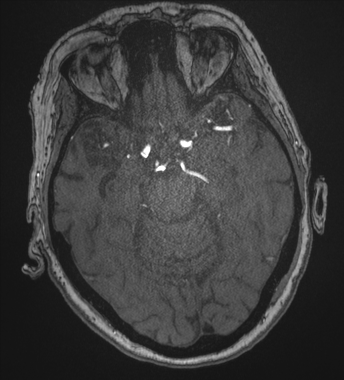 Bilateral fetal posterior communicating arteries (Radiopaedia 41286-44102 Axial MRA 76).png