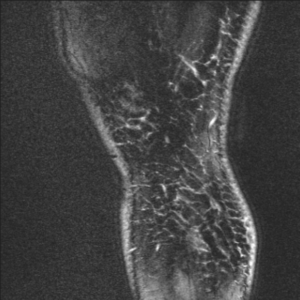 Bilateral focal pigmented villonodular synovitis (Radiopaedia 67643-77073 Sagittal T1 vibe 1).jpg
