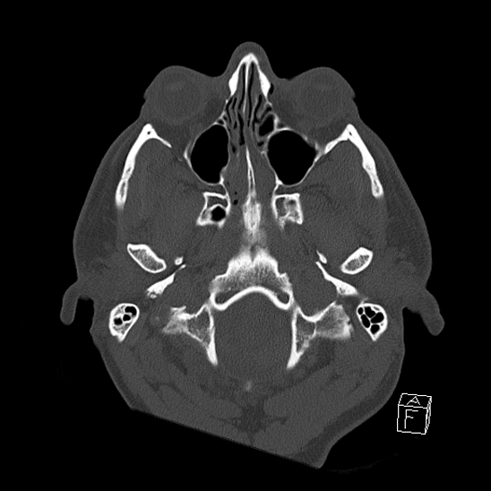 Bilateral occipital condyle fracture (type 2) (Radiopaedia 87675-104089 Axial bone window 14).jpg
