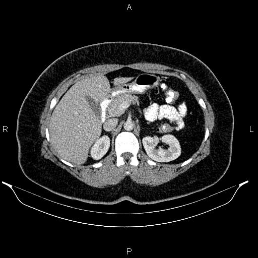 Bilateral ovarian dermoid cysts (Radiopaedia 85785-101603 A 38).jpg