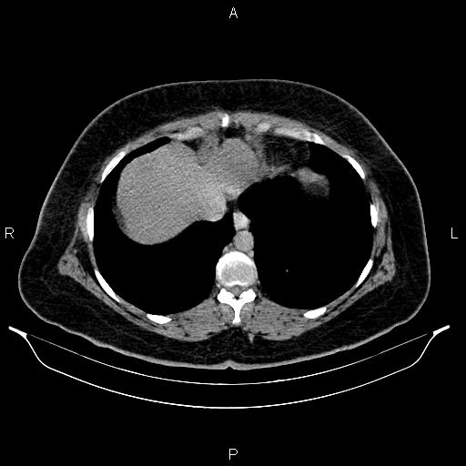 Bilateral ovarian dermoid cysts (Radiopaedia 85785-101603 Axial C+ delayed 1).jpg