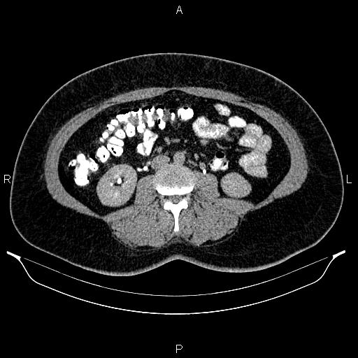 File:Bilateral ovarian dermoid cysts (Radiopaedia 85785-101603 Axial C+ delayed 38).jpg