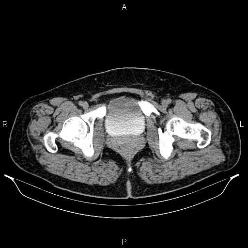 File:Bilateral ovarian dermoid cysts (Radiopaedia 85785-101603 Axial C+ delayed 86).jpg