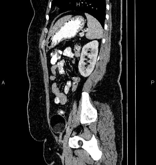 File:Bilateral ovarian dermoid cysts (Radiopaedia 85785-101603 D 70).jpg